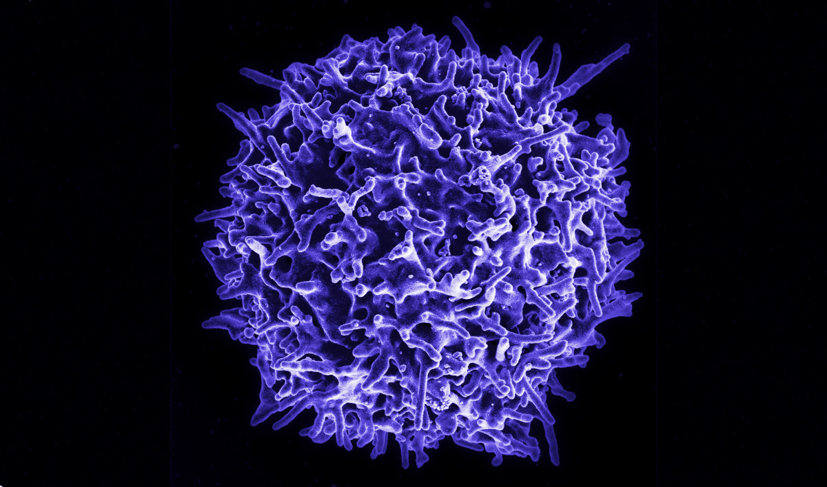 Linfoma primario cutáneo agresivo epidermotrópico de células T CD8+