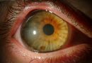 Megalocornea-aislada-congenita