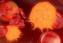 CAR-T Cell Therapy