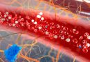 Los-pacientes-de-anemia-con-MDS-se-benefician-con-Luspatercept-en-la-carga-de-transfusion.