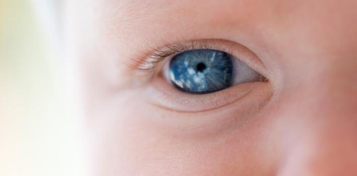 retinoblastoma