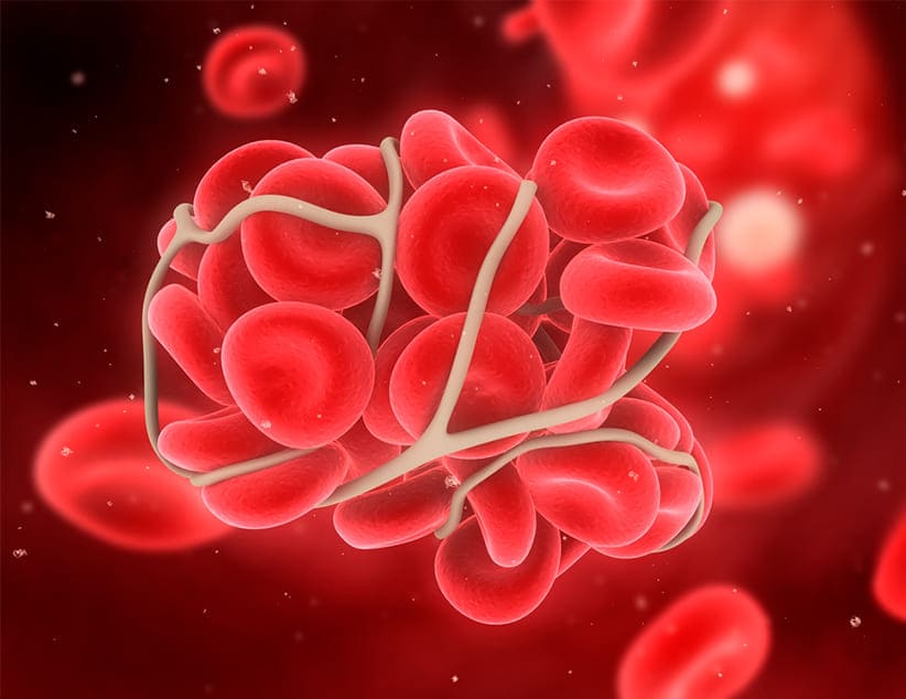 Diferencias entre trombosis venosa profunda y trombosis venosa superficial