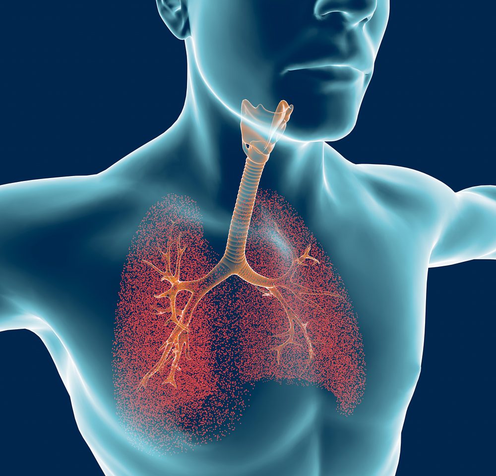 Ciertos pacientes con PH asociado a la sarcoidosis podrían beneficiarse de un tratamiento específico para el PH, sugiere un estudio del mundo real