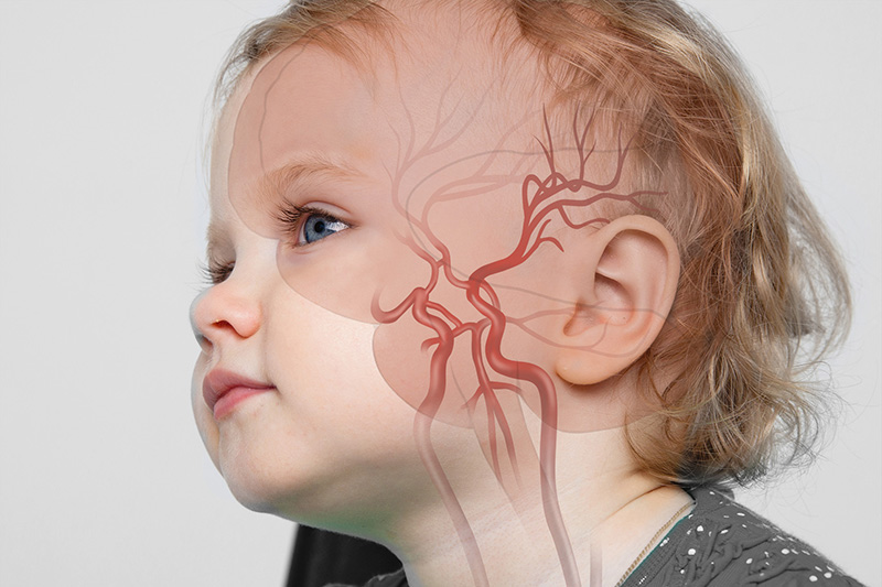 Medicamento antiinflamatorio detiene los accidentes cerebrovasculares en niños con enfermedades raras