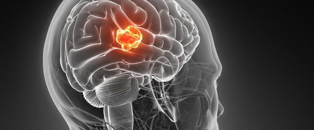 glioblastoma, hormona prolactina, hombres