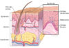 Melanoma