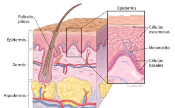 Melanoma