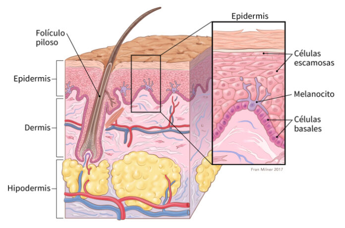 Melanoma