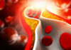 vasculitis-enfermedad-Behçet,embolia