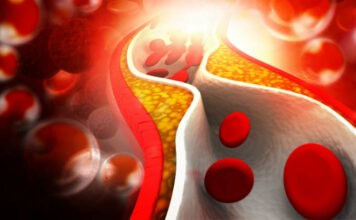 vasculitis-enfermedad-Behçet,embolia