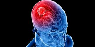 tumor cerebral, glioma