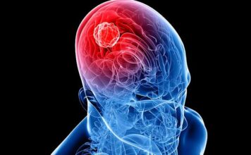 tumor cerebral, glioma