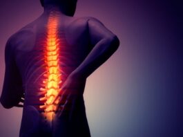 Espondilitis Anquilosante
