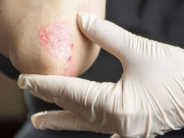 psorisis pediátrica, espondilitis anquilosante, espondiloartritis, FDA, terapia sistémica