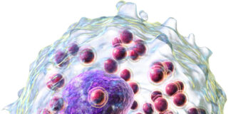 síndromes Hipereosinofílicos