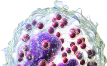 síndromes Hipereosinofílicos