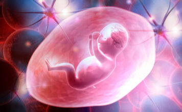 Leucoencefalopatía megalencefálica con quistes subcorticales