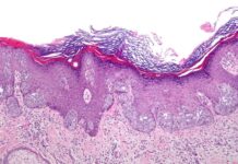 cáncer de piel, melanoma