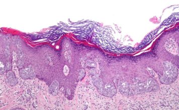 cáncer de piel, melanoma