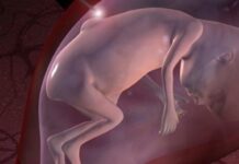 cirugía de espina bífida fetal, restaurar la estructura cerebral