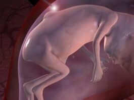 cirugía de espina bífida fetal, restaurar la estructura cerebral