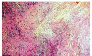 Sarcoma epitelioide