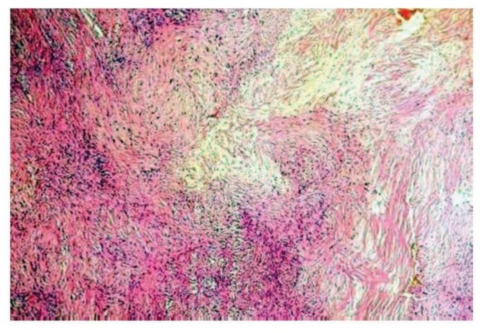 Sarcoma epitelioide