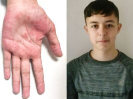 Lewis Greig, COVID-19, enfermedad autoinmune