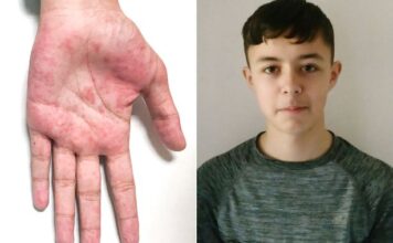 Lewis Greig, COVID-19, enfermedad autoinmune