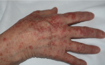 manifestaciones cutáneas, COVID-19