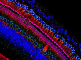 células sensoriales oído, síndrome de Usher