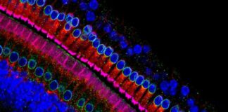 células sensoriales oído, síndrome de Usher