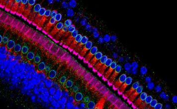 células sensoriales oído, síndrome de Usher