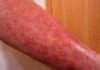 psoriasis, uveítis, atritis psoriasica