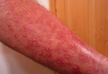 psoriasis, uveítis, atritis psoriasica