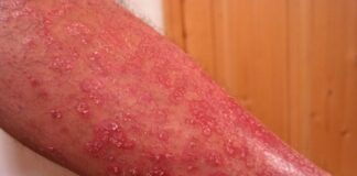 psoriasis, uveítis, atritis psoriasica