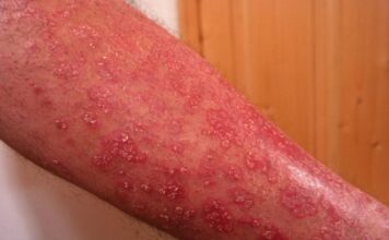 psoriasis, uveítis, atritis psoriasica