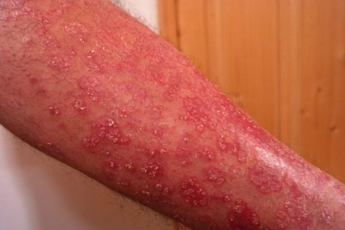 psoriasis, uveítis, atritis psoriasica