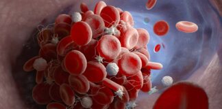 detección recien nacidos, células falciformes