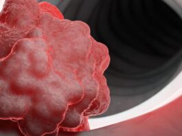 fármaco, tumor gastrointestinal, avapritinib