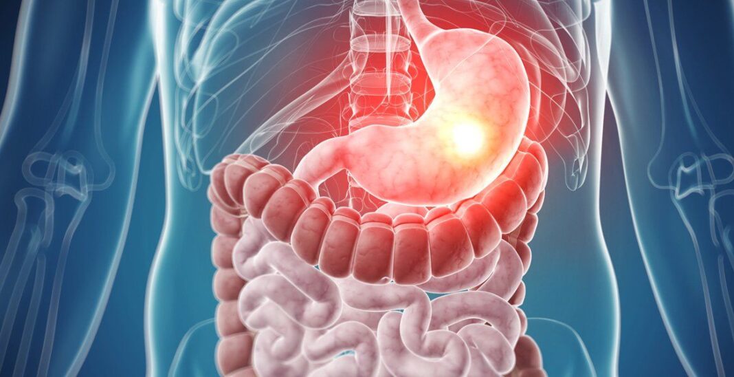 tumores del estroma gastrointestinal