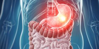 tumores del estroma gastrointestinal