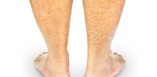 Estudio genético de la afección ictiosis laminar