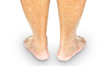 Estudio genético de la afección ictiosis laminar