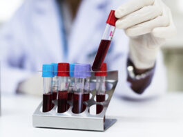 ensayo clínico para tratamiento experimental de ELA