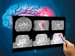 tumor cerebral, investigaciónes_biomédicas