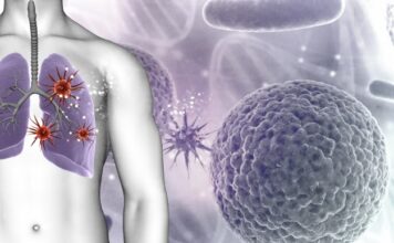 terapia mesotelioma pleural maligno