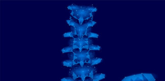 características clínicas osteomielitis crónica no bacteriana