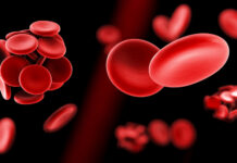 prueban terapia génica, anemia falciforme