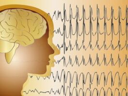 Análisis descriptivo electroencefalograma síndrome de Angelman